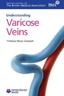Book cover of Understanding Varicose Veins